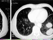 Rola tłuszczy omega-3 w leczeniu raka płuc pacjent: diagnoza: mężczyzna wiek 78 lat rak płuca (malignant fibrous histiocytoma) z