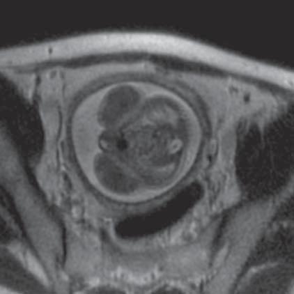 Lack of amniotic fluid, agenesis of kidney (MR of fetus, SST2 sequence, frontal plane) Ryc. 27.