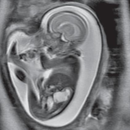 Late phase of obstructive uropathy (MR of fetus, SST2 sequence, sagittal plane) Ryc. 32.