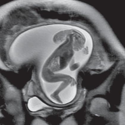 Ryc. 1. Anencefalia (MR płodu, sekwencja SST2, płaszczyzna strzałkowa) Fig. 1. Anencephaly (MR of fetus, SST2 sequence), sagittal plane) Ryc.