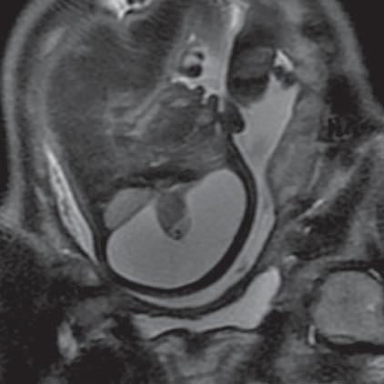 Hydranencephaly (MR of fetus, SST2 sequence, sagittal plane) Ryc. 3.