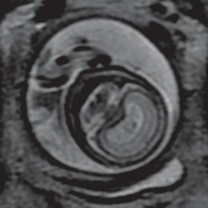 Holoprosencephaly (MR of fetus, SST2 sequence, frontal plane) Ryc. 4.