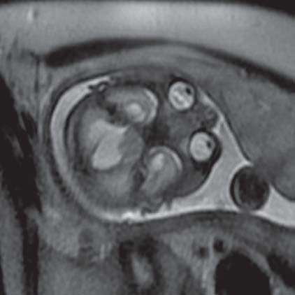 Schizencephaly (MR of fetus, SST2 sequence, frontal plane) Ryc. 5.