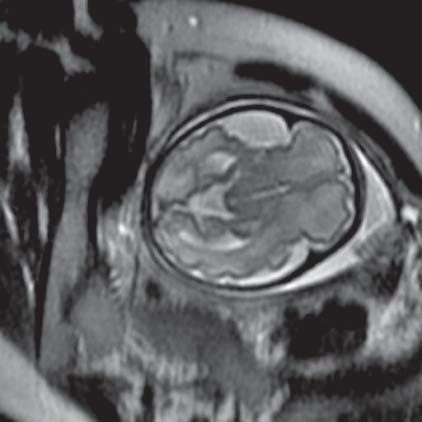 Cyst of arachnoid (MR of fetus, SST2 sequence, transverse plane) Ryc. 8.
