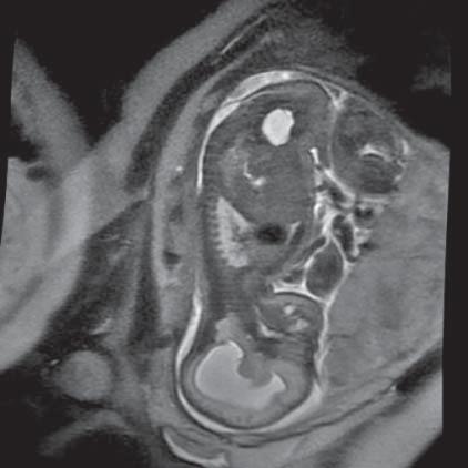 Arnold-Chiari Syndrome (MR of fetus, SST2 sequence, sagittal plane) Ryc. 9.