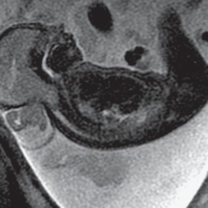 Occipital encephalocele (MR of fetus, SST2 sequence, sagittal plane) Ryc. 10.
