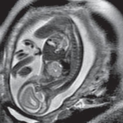 Teratoma of mediastinum (MR of fetus, SST2 sequence, sagittal plane) Ryc. 16.