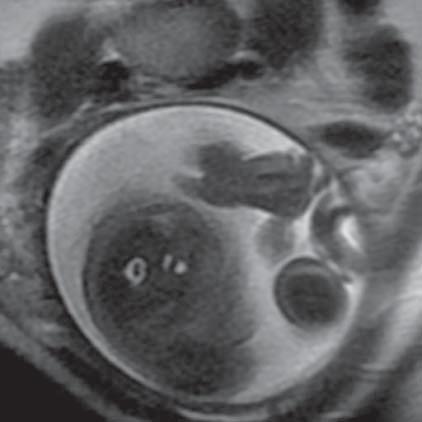 Hypoplasia of fetal lungs (MR of fetus, SST2 sequence, sagittal plane) Ryc. 17.