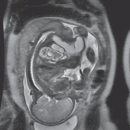 Rezonans magnetyczny płodu nowa metoda diagnostyczna w algorytmie prenatalnej opieki