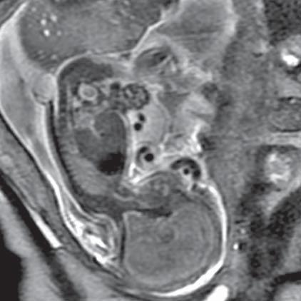 Umbilical hernia (liver, gallbladder) (MR of fetus, SST2 sequence, sagittal plane) Ryc. 21.