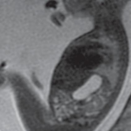 Prune-Belly Syndrome (MR of fetus, SST2 sequence, sagittal plane) Ryc. 23.