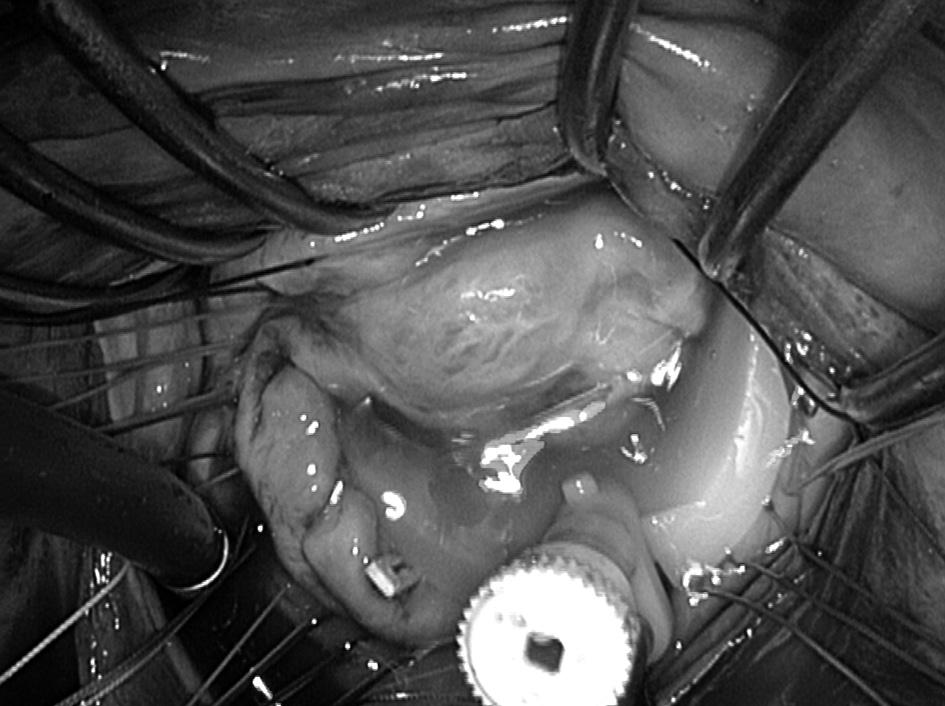 Wykonana po 3 miesiącach przezklatkowa ultrasonografia (USG) serca wykazała dobry efekt plastyki, nieistotną falę zwrotną (zasięg w dopplerze kolorowym 1+), powierzchnię lewego ujścia żylnego 1,6 1,8