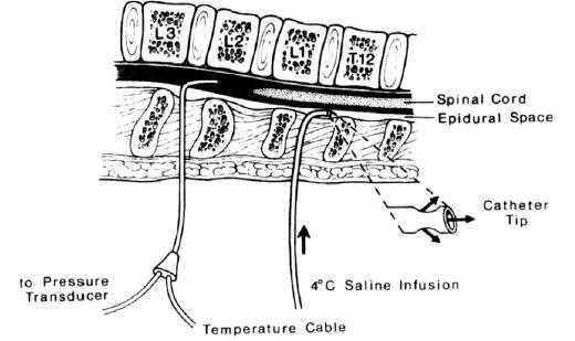 Regionalna hipotermia: T 10 12: cewnik zewnątrzoponowy założony 4 5 cm dogłowowo L 3 4: cewnik podpajęczynówkowy założony dla ciągłego monitoringu CSFP i temperatury Chłodzenie: podaż ciągła soli