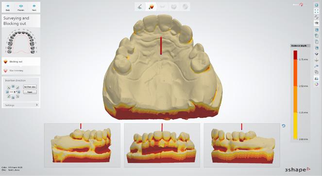 Prosta budowa bibliotek protez Oprogramowanie Dental System 2015 firmy 3Shape oferuje nowe, wspaniałe narzędzia do tworzenia bibliotek kontroli uzębienia w uśmiechu z wykorzystaniem wzorca Monsona,