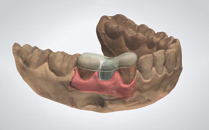 Linia preparacji jest automatycznie wyodrębniana na przecięciu pomiędzy projektem anatomicznym a nieopracowanym zębem.