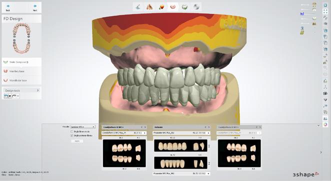 Umiejscawianie prowadnic w celu dokładnego, łatwego umieszczania łączników Użytkownik może pomóc dentyście w łatwym i precyzyjnym umieszczeniu łączników, uzupełnień tymczasowych lub licówek dzięki