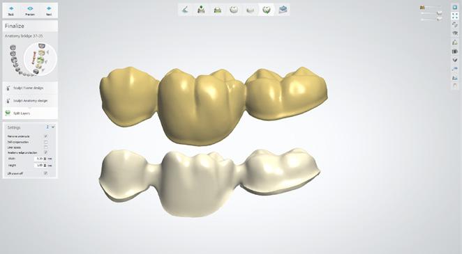 protez dentystycznych w czasie frezowania, dodano nową opcję Ochrona krawędzi anatomii.