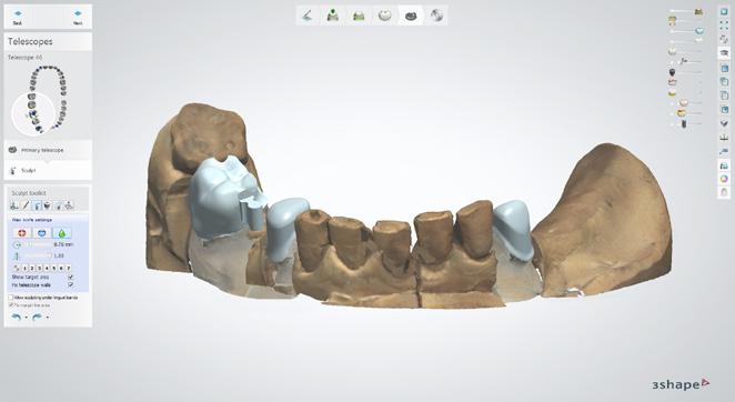 Abutment Designer nowe biblioteki i ochrona grubości materiału Oprogramowanie 3Shape Dental System współpracuje obecnie z ponad 50 bibliotekami implantów.