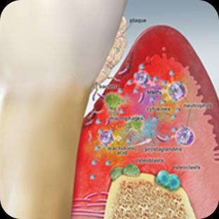 Początkowe stadium zapalenia przyzębia Zaawansowane
