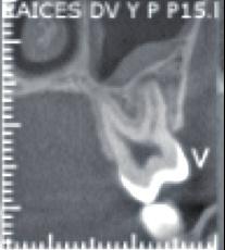 Tomografia pokazująca sytuację kliniczną w lewym drugim