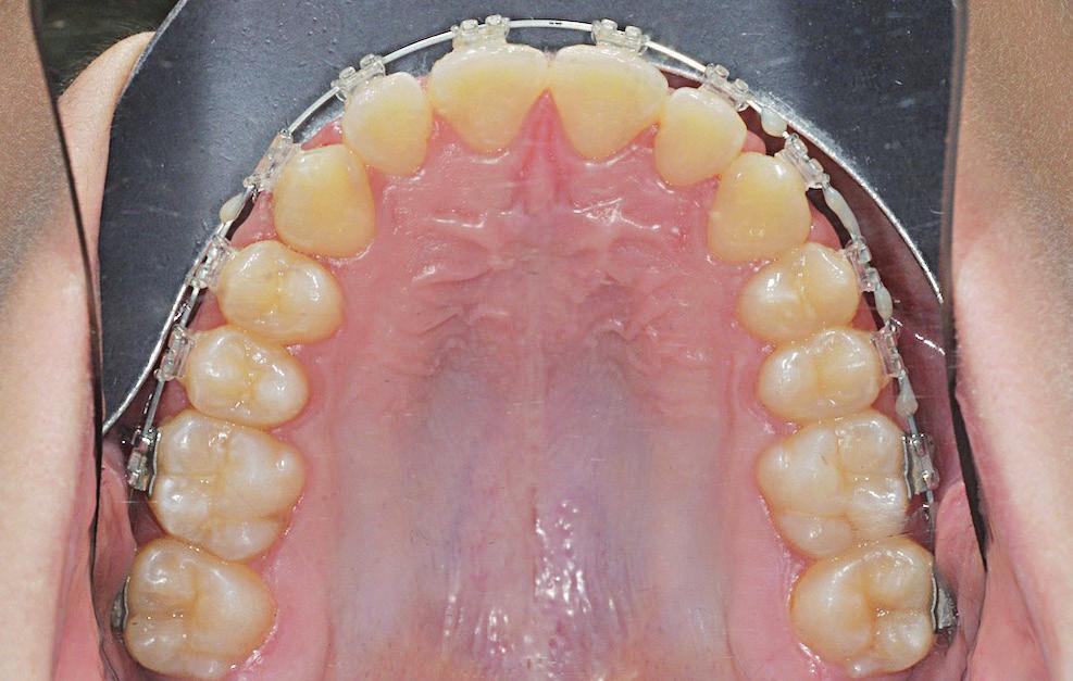 Widok od strony okluzyjnej ukazujący prawidłowe wyrównanie bruzd środkowodystalnych zębów trzonowych i przedtrzonowych, aspekt fundamentalny do osiągnięcia prawidłowego zgryzu.