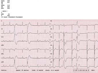 Folia Cardiologica 2018, tom 13, nr 1 Rycina 2.