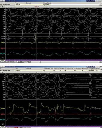 W wykonanym kontrolnie badaniu EKG metodą Holtera zarejestrowano pojedyncze dodatkowe pobudzenia komorowe w liczbie 3,717/dobę (tj. 4% rytmu dobowego).