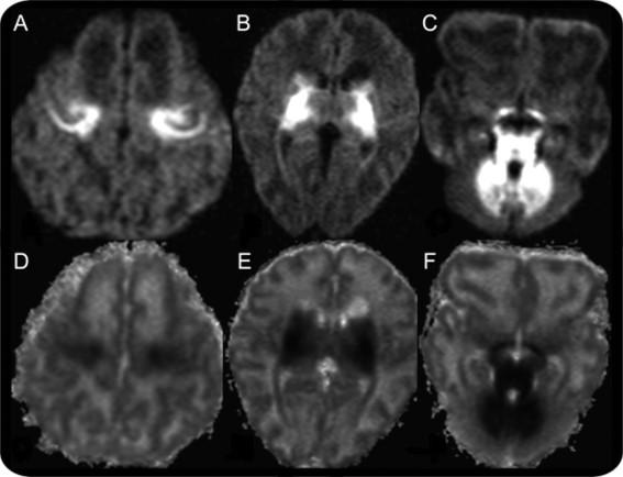 Neurology 2010; 74(3):e12-e12 Infekcje z grupy TORCH Spektrum objawów jest zależne od momentu zakażenia Zapalenie mózgu i opon o wieloogniskowym i martwiczym