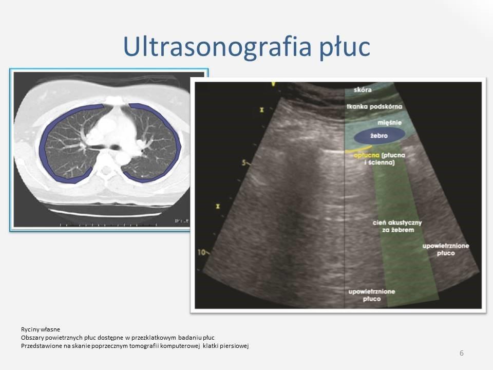 Zakrzepica zatok żylnych i żył mózgu u noworodków Podstawą diagnostyki zakrzepicy żył i zatok mózgu