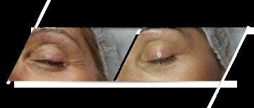 Demakijaż Tonizacja 1 2 3 Płyn Micelarny CERA SUCHA/Up Lift Tonic Remover CERA SUCHA/ Up Washing HYPERPIGMENTATION SKIN 4 Krem Lift Cream Pielęgnacja okolic oczu Lift Peel Eye Cream WSKAZÓWKA