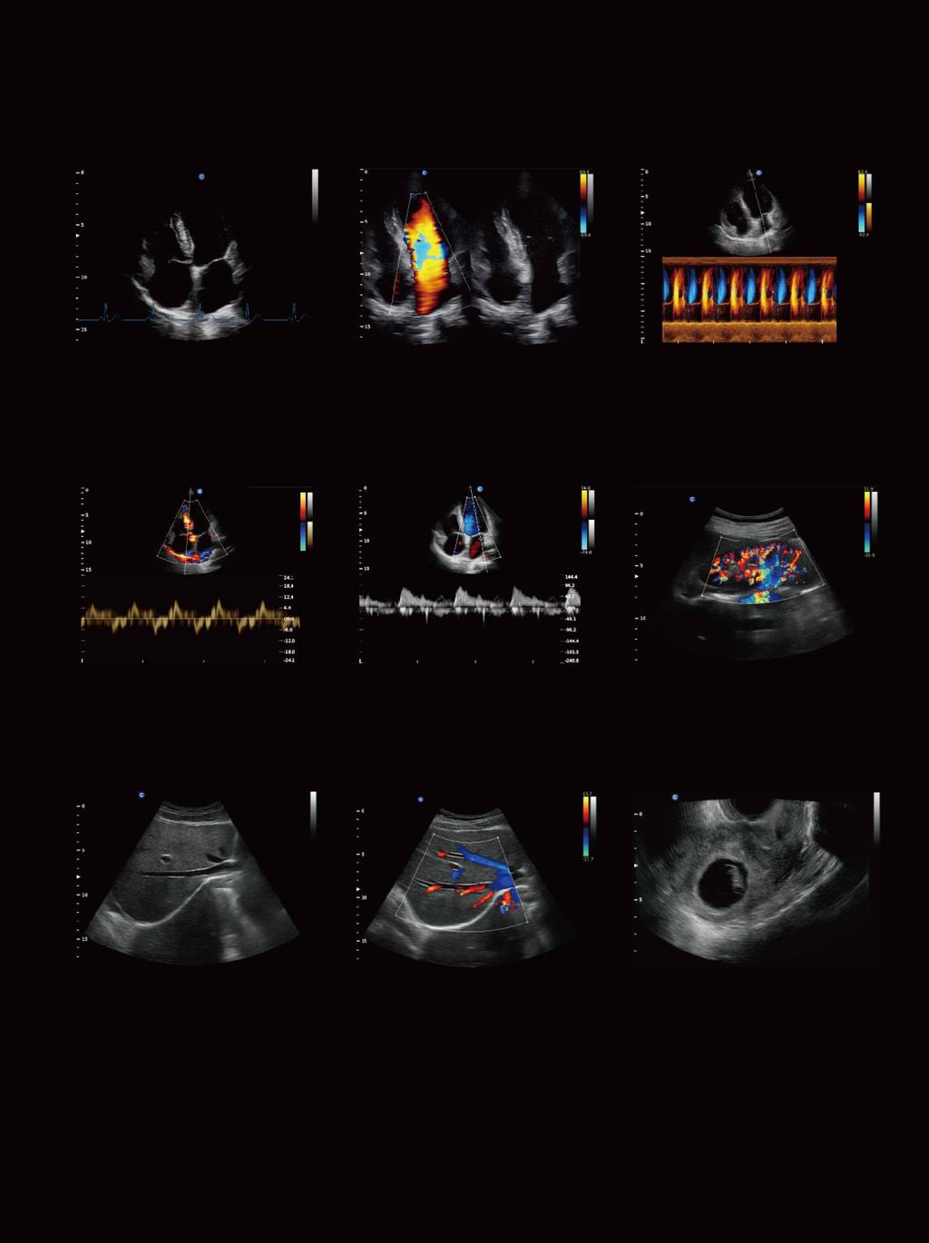 Widok czterech komór, EKG Widok czterech komór, tryb B/BC Widok czterech komór, tryb kolorowy M Widok czterech