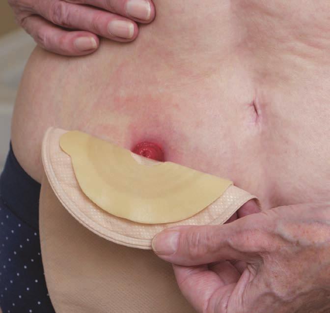 Oczyść skórę wokół stomii, używając przeznaczonych do tego celu środków pielęgnacyjnych.