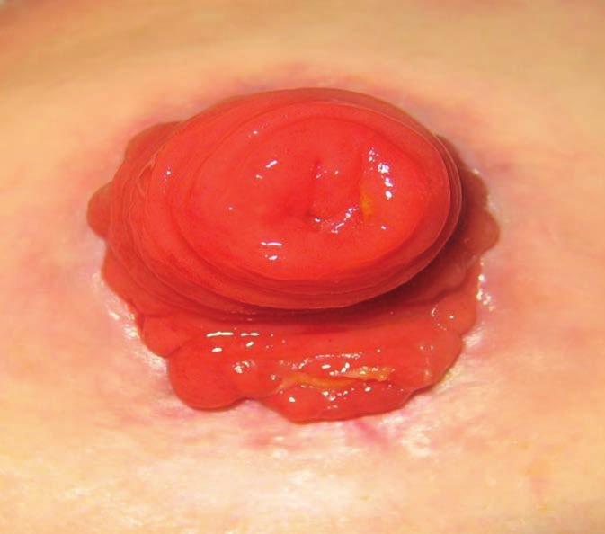 Ileostomia dwulufowa, pętlowa Ileostomię dwulufową (pętlową) najczęściej wytwarza się w celu ochrony zespolenia chirurgicznego w jelicie.