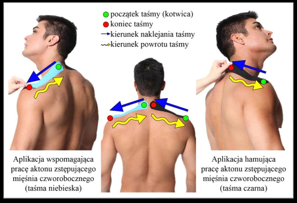 stosowano także w celu poprawy artrokinematyki poprzez zastosowanie aplikacji wspomagającej (zwiększającej napięcie mięśniowe) i hamującej (wpływającej na rozluźnienie napiętych mięśni w spoczynku)