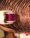 Roller stosuj jedynie w przypadku nasilonego łysienia lub bardzo krótkich włosów. Ryc. 9. Dermapen Ryc. 10.