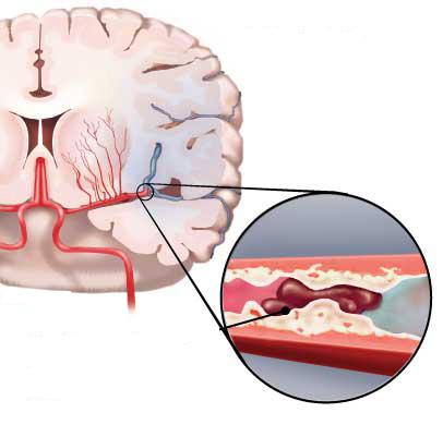 Objawy niedostatecznego ukrwienia pojawiają się, gdy dopływ krwi z prawidłowej ilości 8ml/g masy mózgu obniża się do 3-4ml.