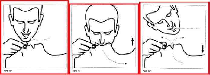 o Metoda usta - usta - ratownik obejmuje swoimi ustami usta poszkodowanego, jednocześnie palcami zatyka nozdrza. Po wykonaniu wdechu zwalnia ucisk nosa.