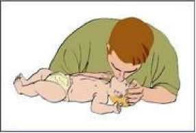 W wentylacji niemowlęcia stosuje się inne metody: o Metoda usta - usta - nos - ratownik obejmuje swoimi ustami jednocześnie usta i nos niemowlęcia.