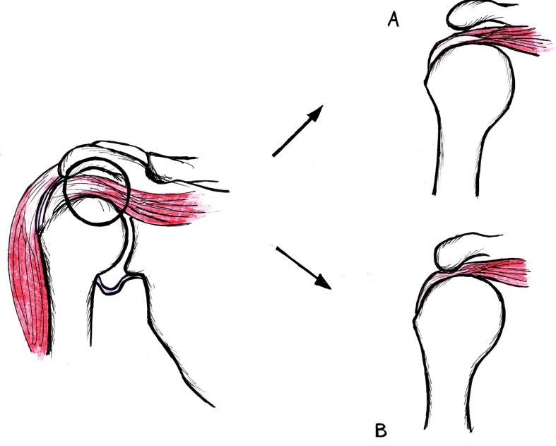 Istotnym, z klinicznego punktu widzenia, miejscem jest strefa krytyczna (ang. critical zone), która znajduje się pomiędzy ścięgnem mięśnia nadgrzebieniowego a więzadłem kruczo-ramiennym.