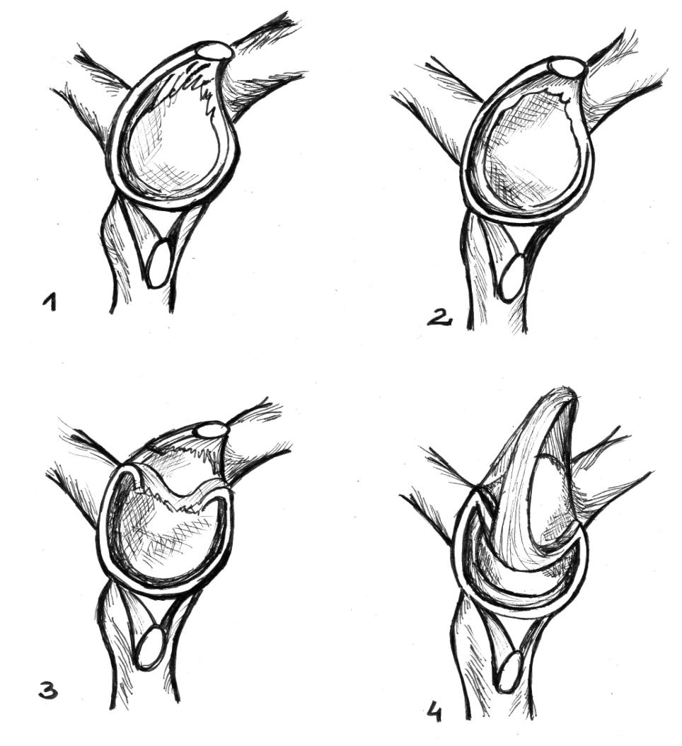 Ryc. 14 Typy uszkodzeń obrąbka stawowego: 1-degeneracja, 2-odrywanie obrębka od panewki, 3-oderwanie obrąbka, 4-oderwanie obrąbka wraz ze ścięgnem głowy długiej mięśnia dwugłowego ramienia (wzorowane