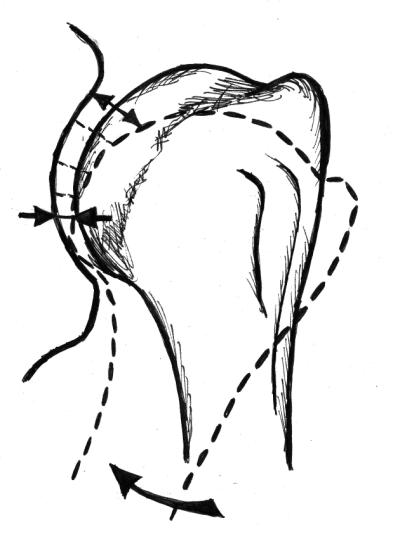 Jednocześnie przesunięciu ulega środek obrotu znajdujący się na głowie kości ramiennej. Zaburzony zostaje rytm łopatkowo-ramienny. Zmniejsza się luz stawowy dolnej części torebki stawu ramiennego.