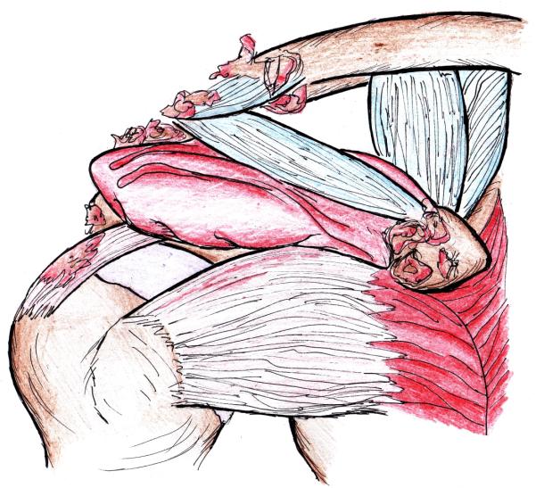 Obkurczeniom torebki stawowej towarzyszą więzadła i mięśnie. Specyficzne jest początkowe ograniczenie rotacji zewnętrznej, jako wyniku przykurczu przedniej części torebki i więzadła kruczo-ramiennego.