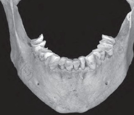 Żuchwa burłaka z Orkadów Burłak z Orkanów zaciskał zęby tysiące razy, tak bardzo, że uległy one starciu (Molleson 2007, s.5-33).
