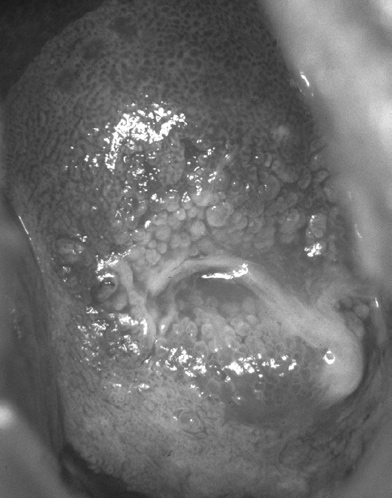 COLPOSCOPY IN MODERN GYNECOLOGY AND OBSTETRICS 11 BIBLIOGRAPHY Fig. 10. HPV infection. The epithelium contains a slightly papillary surface Fig. 11. HPV infection. The unstained cytological smear inspected through the phase-contrast microscope.