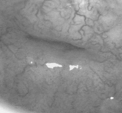 In this way we are swiftly running away from a screening based on a cytology and colposcopy towards the one which depends on hybridization tests [3].