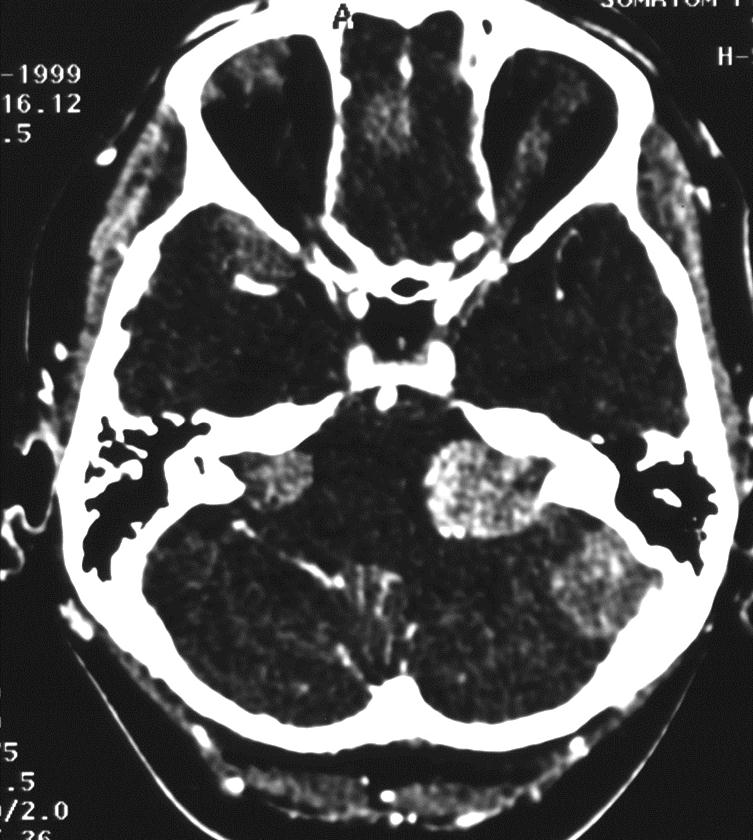 Nerwiakowłókniakowatość neurofibromatosis typ I obwodowy typ II ośrodkowy choroba Recklingchausena - zmiany