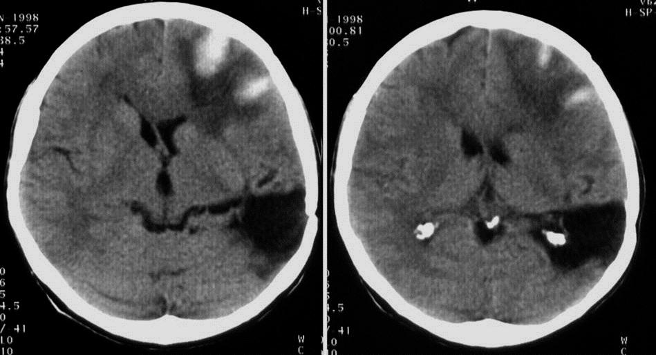 Tzw. stary udar mózgu malacja tkanek mózgu w obszarze tętnicy środkowej stary udar