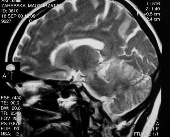 Stwardnienie rozsiane sclerosis multiplex tzw plaki demielinizacyjne (co najmniej 3 typowy kształt i