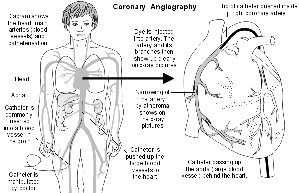 Angiografia tętnic wieńcowych