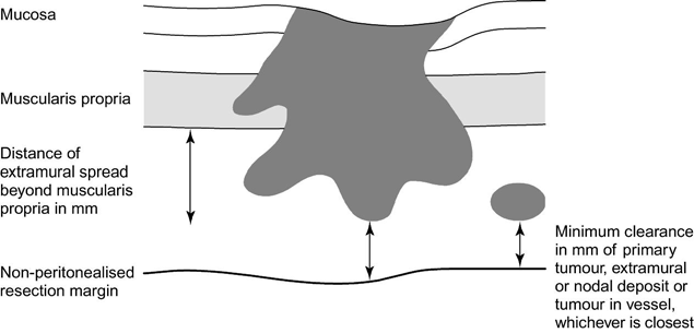 cells STANDARD OCENY PATOMORFOLOGICZNEJ DLA RESEKCJI JELITA Z GUZEM III. OCENA MIKROSKOPOWA 1. Typ histologiczny guza 2. Stopień zróżnicowania histologicznego 3.